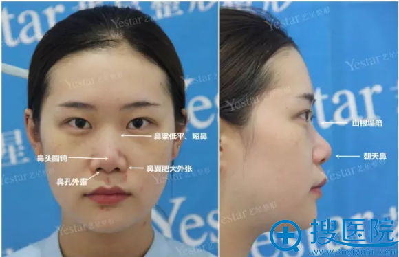 杭州艺星隆鼻案例术前留影 杭州艺星隆鼻案例术前留影