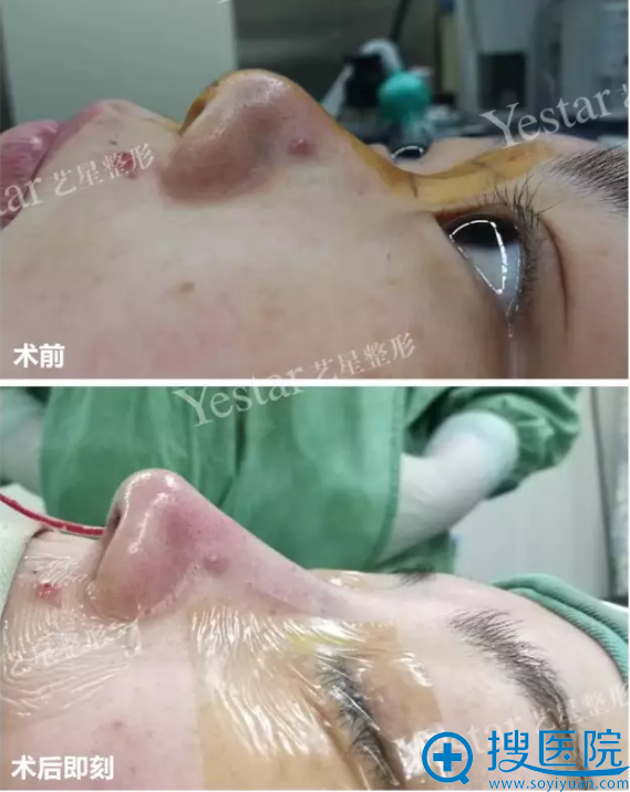 杭州艺星肋软骨隆鼻术后即刻效果 杭州艺星肋软骨隆鼻术后即刻效果