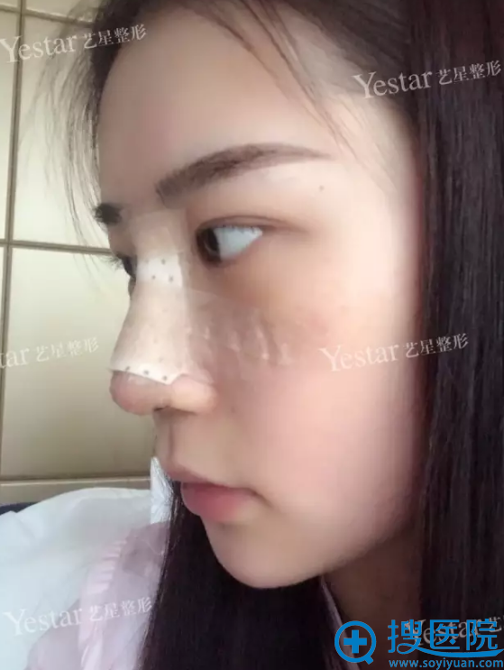 隆鼻术后第二天自拍 隆鼻术后第二天自拍