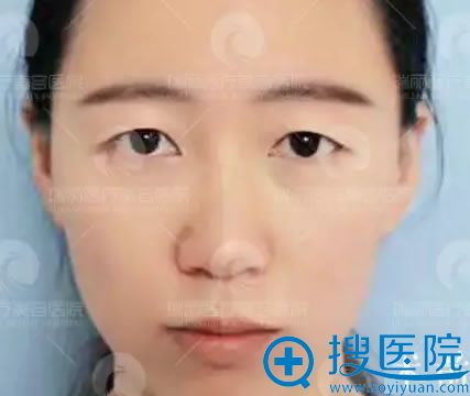 在<!--<i data=20240710 data-id=12625></i>-->整形医院做双眼皮术前照 在<!--<i data=20240710 data-id=12625></i>-->整形医院做双眼皮术前照