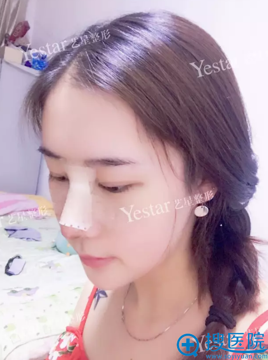 隆鼻术后第五天恢复期的样子 隆鼻术后第五天恢复期的样子