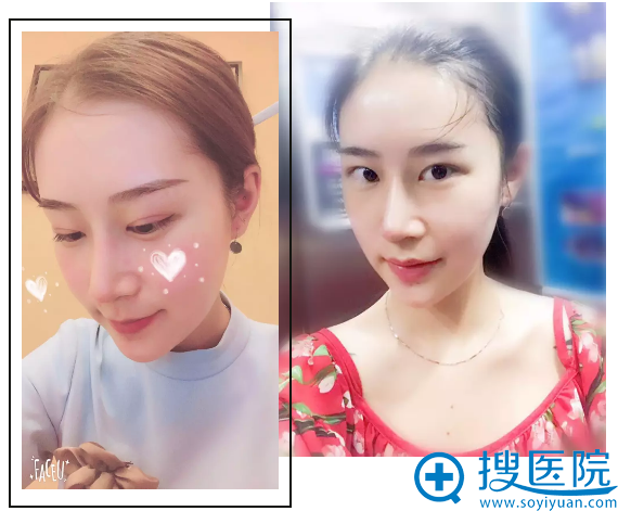 隆鼻术后15天效果图 隆鼻术后15天效果图