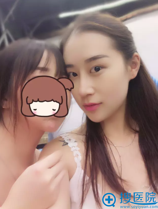 隆鼻术后一个月自拍 隆鼻术后一个月自拍