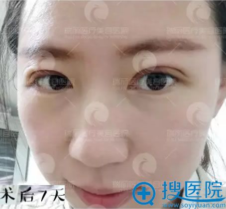 眼睛整形术后7天拆线后的样子 眼睛整形术后7天拆线后的样子