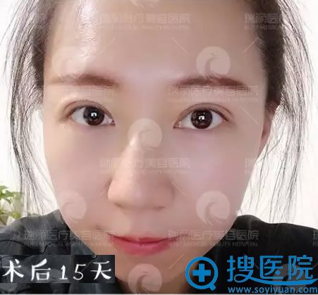 刘明飞院长双眼皮术后15天恢复效果 刘明飞院长双眼皮术后15天恢复效果