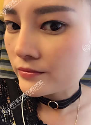 鼻子做完假体1周能恢复到什么样子 妹子注射物取出再修复效果