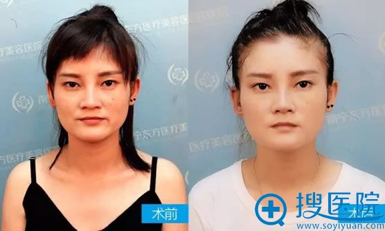 隆鼻手术一周能恢复好吗 隆鼻手术一周能恢复好吗