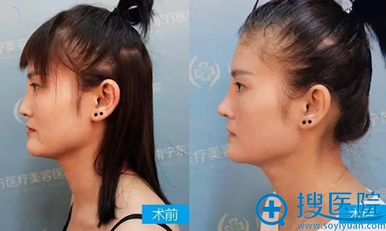 鼻修复手术一周恢复的效果 鼻修复手术一周恢复的效果