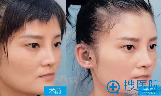 假体隆鼻一周恢复的效果图 假体隆鼻一周恢复的效果图