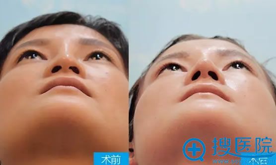 隆鼻7天后躺着看鼻子的效果 隆鼻7天后躺着看鼻子的效果