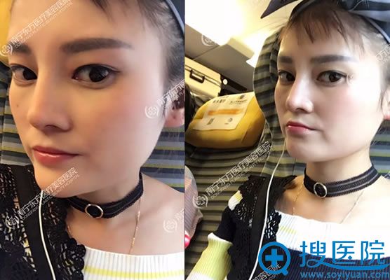隆鼻手术7天能化妆吗 隆鼻手术7天能化妆吗