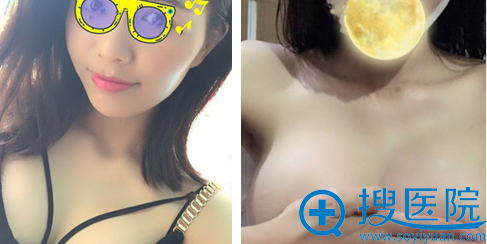太原时光王秀红假体隆胸半个月恢复情况 太原时光王秀红假体隆胸半个月恢复情况