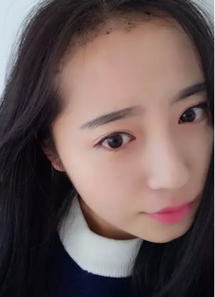20岁美女在吴氏嘉美门诊部种植发际线前后对比照片