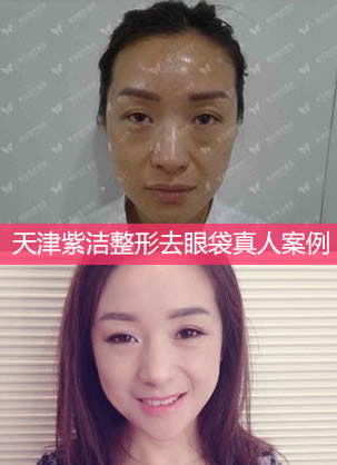 天津紫洁医疗美容医院王椿燕医生非手术去眼袋真人案例