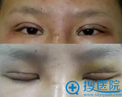 常州施尔美整形双眼皮术后1天睁眼闭眼效果 常州施尔美整形双眼皮术后1天睁眼闭眼效果