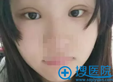 常州施尔美整形美容医院双眼皮术后10天效果 常州施尔美整形美容医院双眼皮术后10天效果