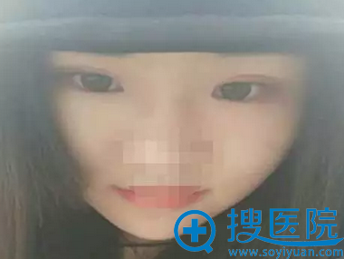常州施尔美整形美容医院双眼皮2个月恢复情况 常州施尔美整形美容医院双眼皮2个月恢复情况