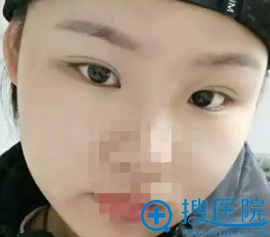 常州施尔美整形美容医院双眼皮手术前后对比照片 常州施尔美整形美容医院双眼皮手术前后对比照片