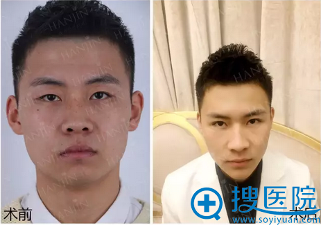 双眼皮案例为你揭秘昆明韩辰整形医院胡乔医生怎么样