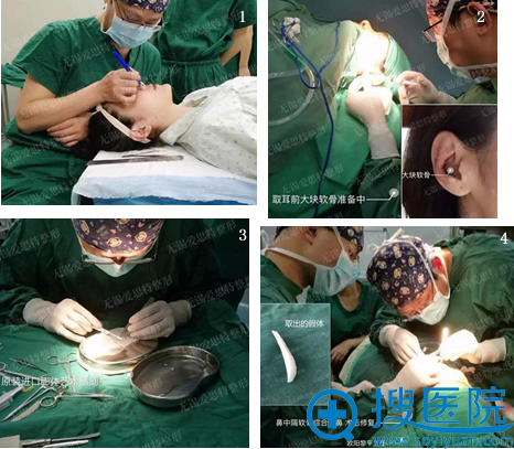 无锡爱思特欧亚路二次隆鼻修复手术过程 无锡爱思特欧亚路二次隆鼻修复手术过程