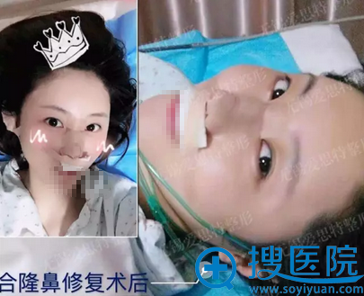 无锡爱思特欧亚路鼻修复术后即刻 无锡爱思特欧亚路鼻修复术后即刻