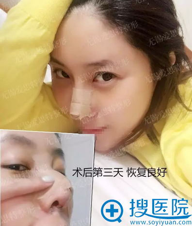 无锡爱思特欧亚路鼻修复术后3天恢复效果 无锡爱思特欧亚路鼻修复术后3天恢复效果