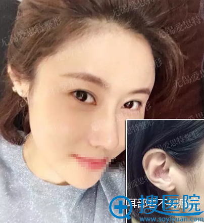 无锡爱思特二次隆鼻修复术后2个月恢复效果 无锡爱思特二次隆鼻修复术后2个月恢复效果