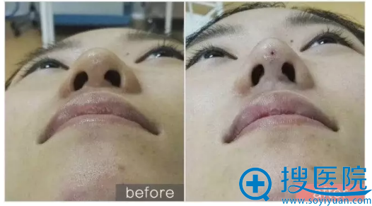 南京华美隆鼻咋样?你没见过的线雕隆鼻手术全过程图片分享