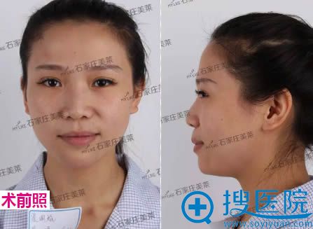 在石家庄美莱整形医院做鼻整形术前照 在石家庄美莱整形医院做鼻整形术前照