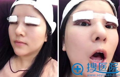 双眼皮失败修复手术即将效果图 双眼皮失败修复手术即将效果图