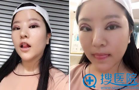 全切双眼皮手术第1天拆纱布照片 全切双眼皮手术第1天拆纱布照片