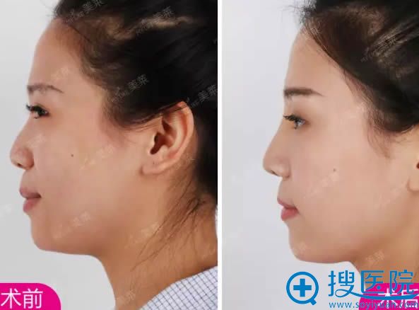 鼻综合恢复期侧面前后对比照 鼻综合恢复期侧面前后对比照