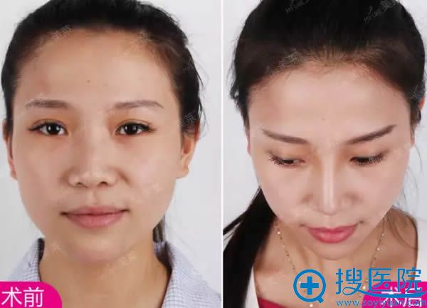 耳软骨鼻综合整形正面前后对比效果 耳软骨鼻综合整形正面前后对比效果