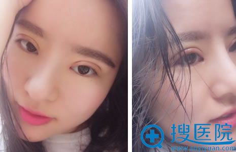 开眼角手术7天拆线效果 开眼角手术7天拆线效果