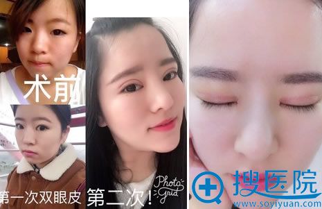 双眼皮修复手术第15天恢复图 双眼皮修复手术第15天恢复图