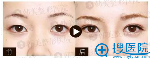 赣州韩美双眼皮案例 赣州韩美双眼皮案例