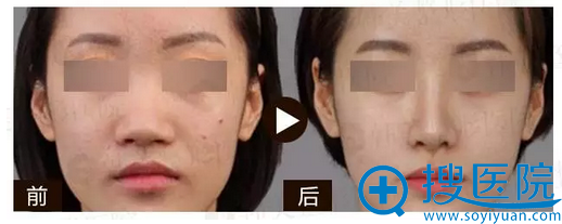 赣州韩美隆鼻案例 赣州韩美隆鼻案例