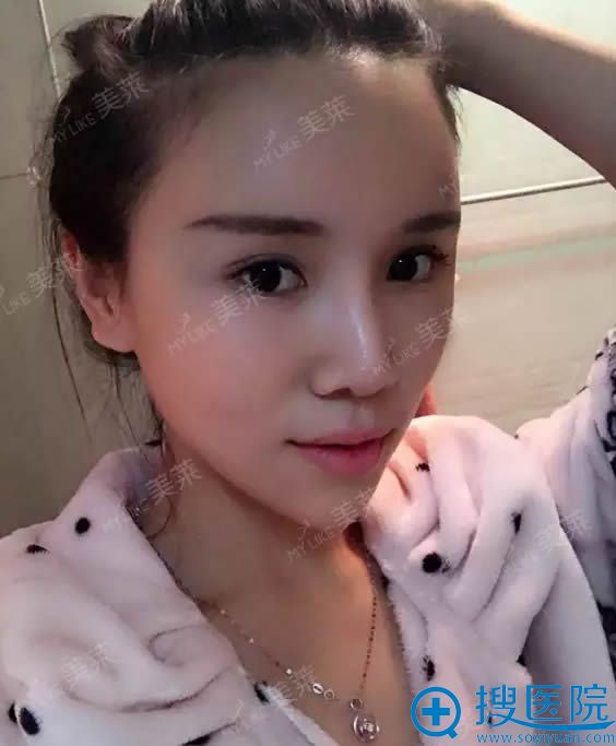 综合鼻整形术后15天恢复效果图 综合鼻整形术后15天恢复效果图