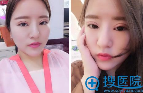 全切双眼皮第25天效果 全切双眼皮第25天效果