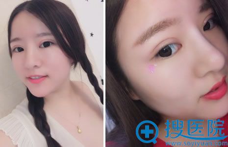 双眼皮失败修复手术第45天图片 双眼皮失败修复手术第45天图片