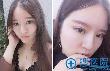 眼部修复手术3个月恢复图片 眼部修复手术3个月恢复图片
