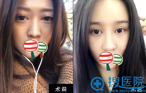 南京克拉美陈明亮全切双眼皮案例 南京克拉美陈明亮全切双眼皮案例