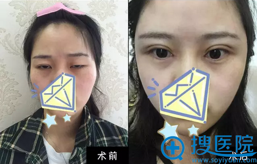 南京克拉美陈明亮全切双眼皮+开眼角案例 南京克拉美陈明亮全切双眼皮+开眼角案例