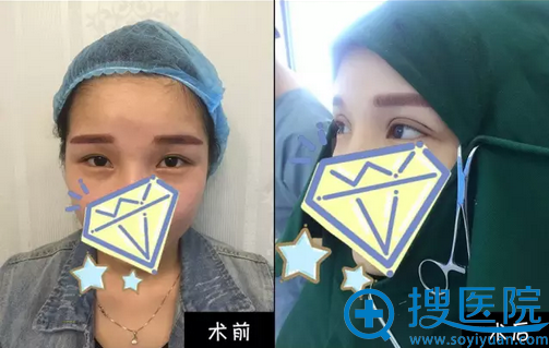 南京克拉美陈明亮扇形双眼皮案例 南京克拉美陈明亮扇形双眼皮案例