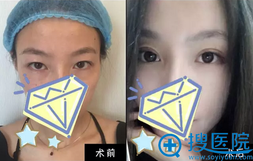 南京克拉美陈明亮欧式大平行双眼皮案例 南京克拉美陈明亮欧式大平行双眼皮案例
