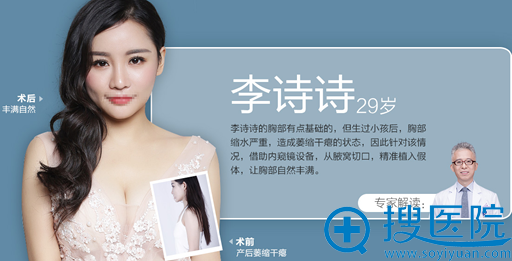 长沙美莱<!--<i data=20240710 data-id=16314></i>-->假体丰胸案例 长沙美莱<!--<i data=20240710 data-id=16314></i>-->假体丰胸案例