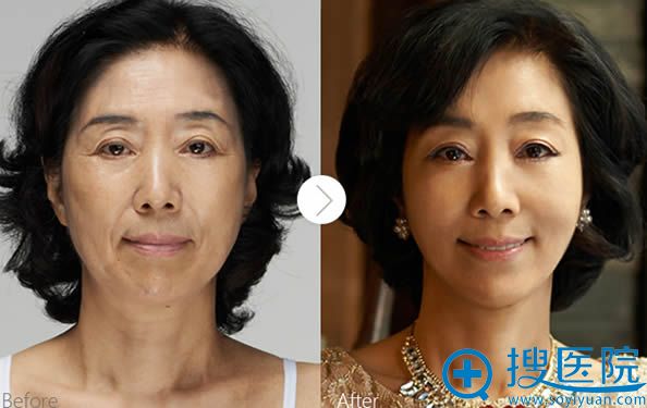 汕头华美自体脂肪面部填充案例 汕头华美自体脂肪面部填充案例