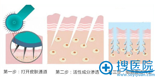 济南伊美尔美颜微针祛痘案例效果图分享 一针焕颜横扫肌肤问题