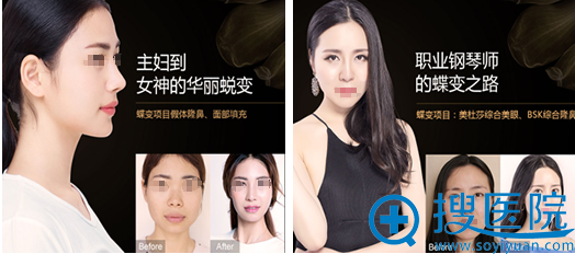 杭州艺星整形美容医院塑美案例 杭州艺星整形美容医院塑美案例