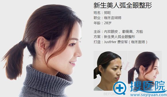 <!--<i data=20240710 data-id=10239></i>-->费医生双眼皮案例 <!--<i data=20240710 data-id=10239></i>-->费医生双眼皮案例